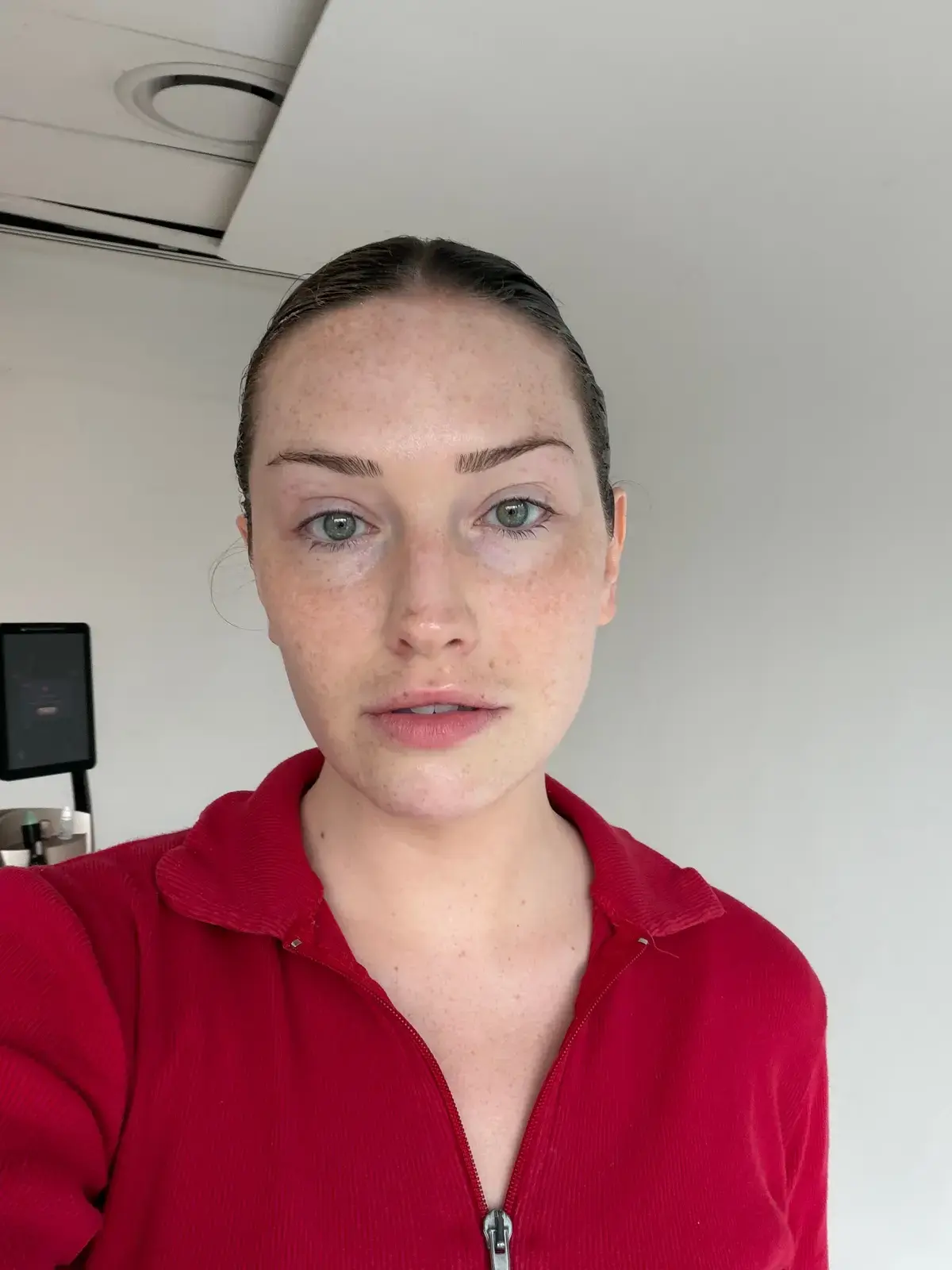 Radiofrequency Therapy Sculpts Jawline and Lifts Face