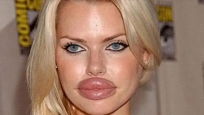 Why Can't We Get Enough of Botched Beauty Procedures?